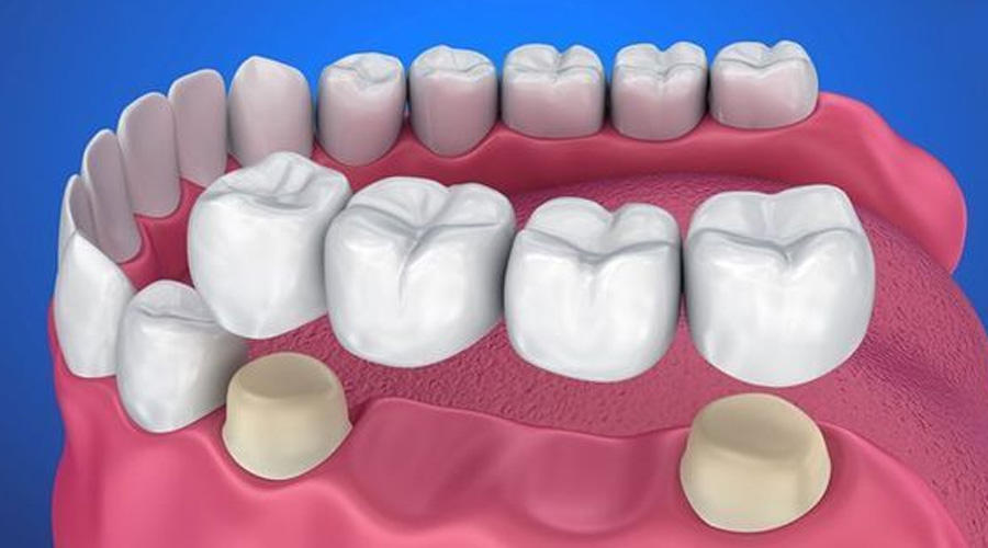 Happy person with braces